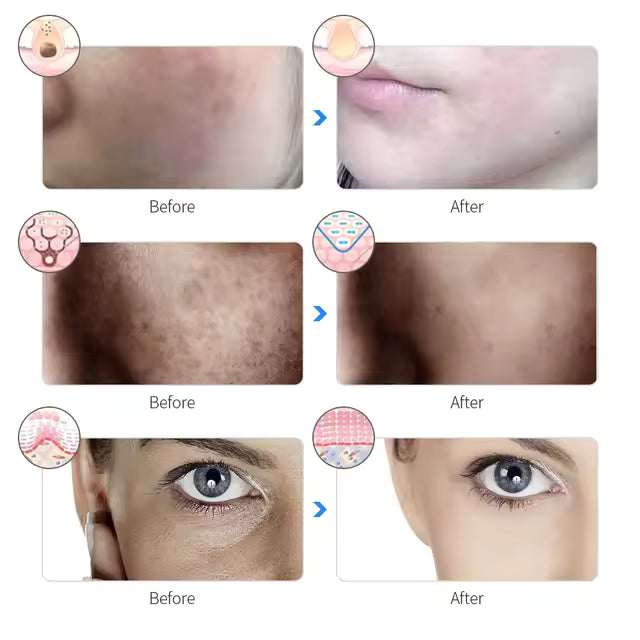 Rechargeable LED Light Therapy Facial Mask