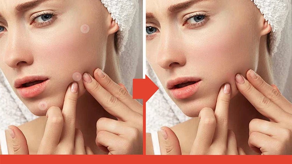 Invisible Pimple Patch Set - PURE VIBE LIMTED