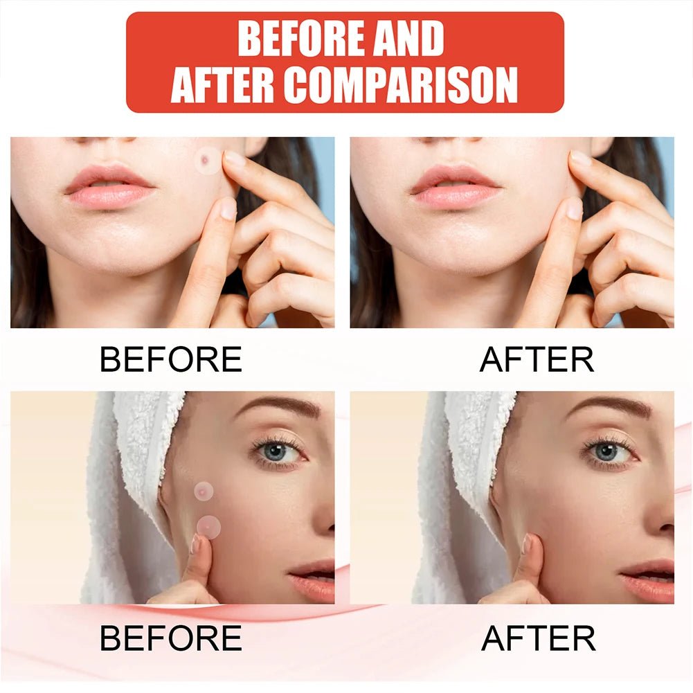 Invisible Pimple Patch Set - PURE VIBE LIMTED